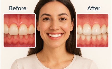 From Uneven Gums to Confident Smiles: Sands & Smiles Boracay Dental Center and One Global Dental Specialists Launch Advanced Gum Contouring Treatments