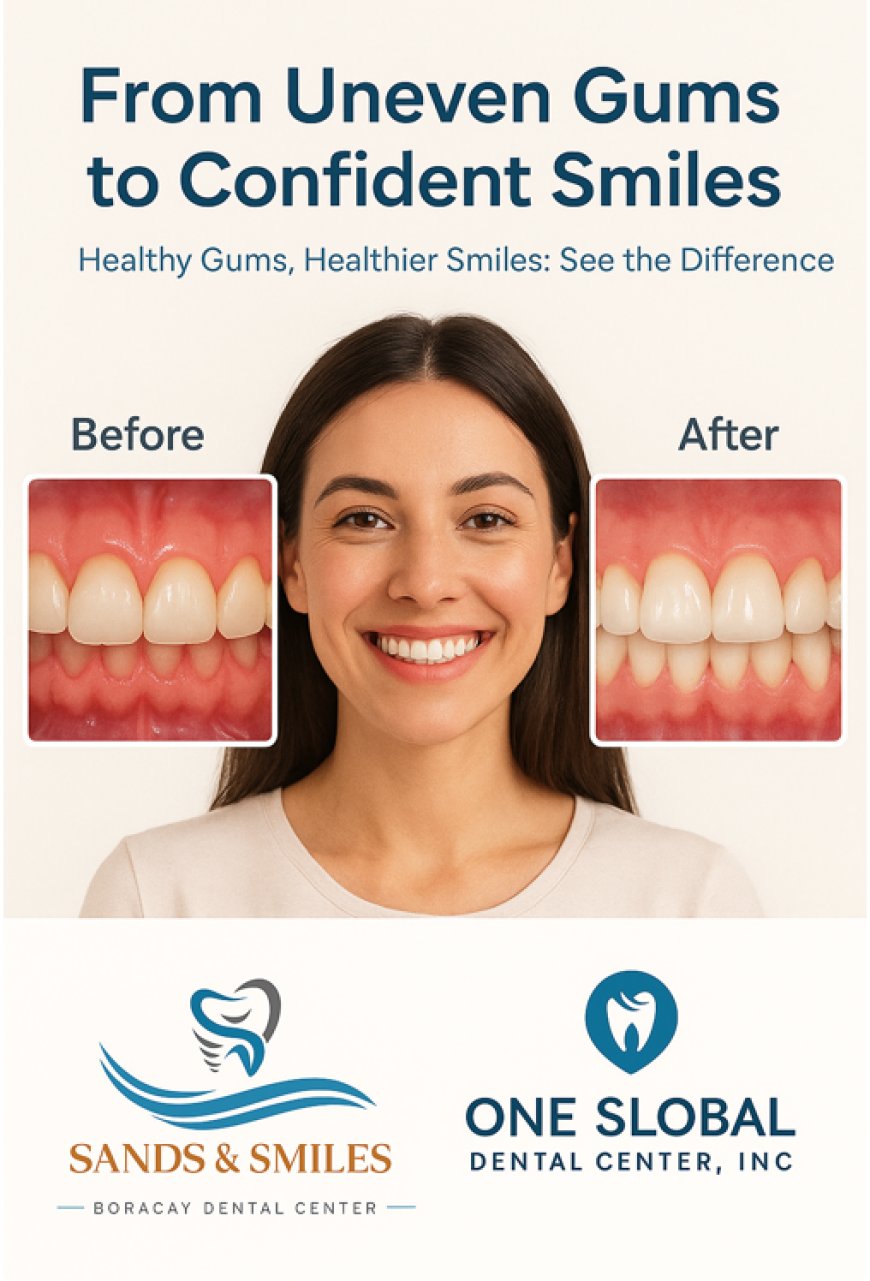 From Uneven Gums to Confident Smiles: Sands & Smiles Boracay Dental Center and One Global Dental Specialists Launch Advanced Gum Contouring Treatments